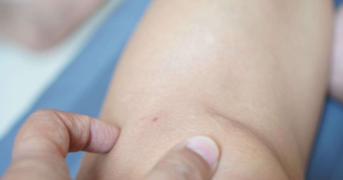 Cancer specialist explains why women get melanoma on legs, and men on chest