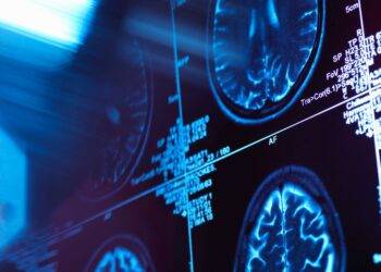 Alzheimer’s study finds ‘vicious cycle’ between excessive napping and disease