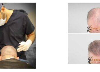 When Is A Hair Transplant The Right Solution For You? Which is the Best Clinic in Belgium?