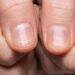 Telltale lung cancer sign in your fingertips that could lead to early diagnosis