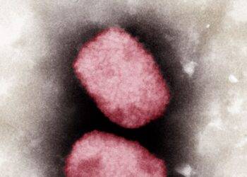 Monkeypox cases in Scotland grow as officials list two reasons to contact doctors