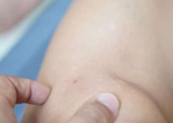 Cancer specialist explains why women get melanoma on legs, and men on chest