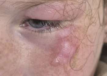 Scots schoolgirl nearly loses eye after toy bought from Tesco explodes in face